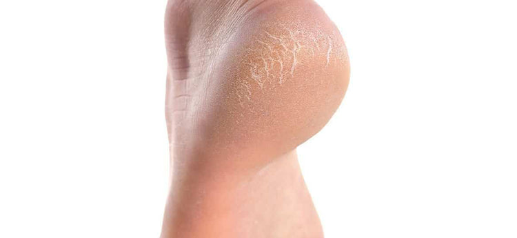 Common Causes Of Cracked Heels