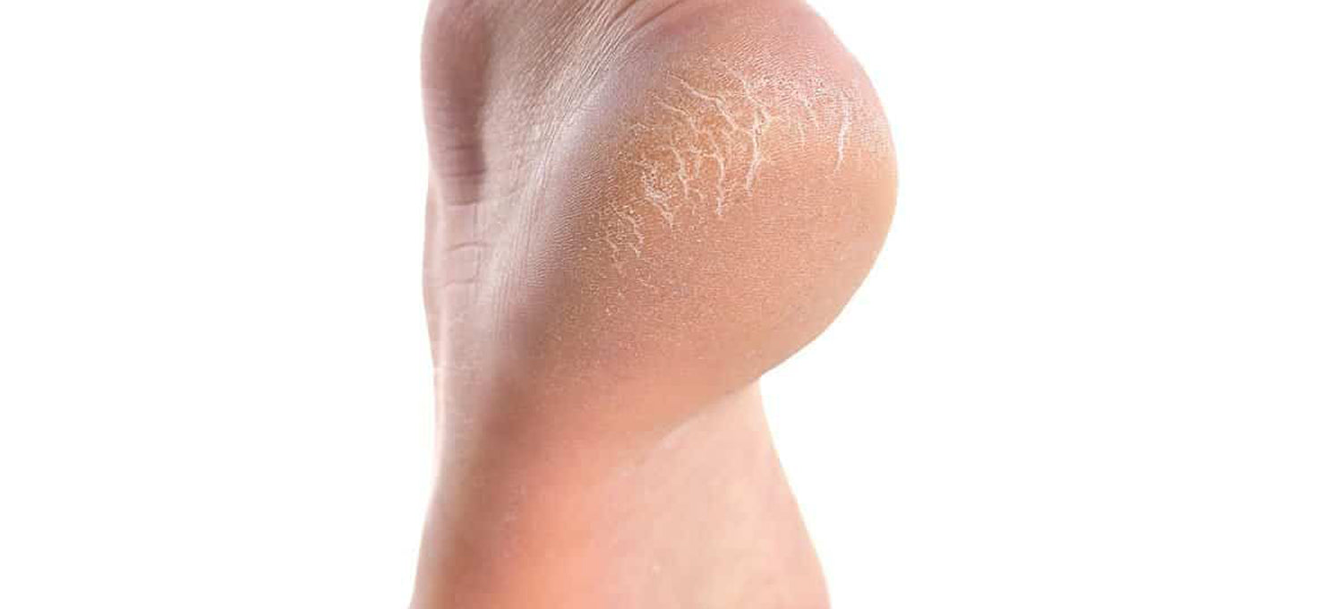 Cracked looking skin on 2025 legs
